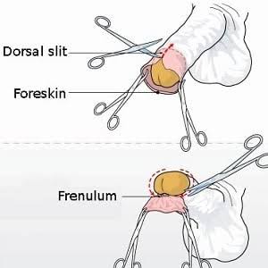 Circumcision, Health Benefits of Circumcision, Religious Practices, Cultural Significance, Medical Procedure, Hygiene and Circumcision, Ethical Issues in Circumcision, Public Health Strategies, Male Circumcision, Rite of Passage, STIs and Circumcision, HIV Prevention, Phimosis Treatment, Infant Circumcision, Circumcision Controversies
